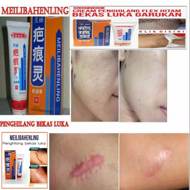 BIO HERBAL Meilibahenling Original Penghilang Bekas Luka HItam Bopeng Koreng /Jerawat Permanen