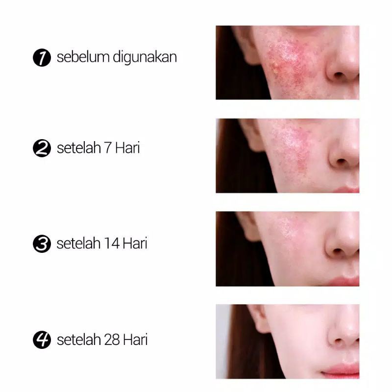 【asli】BREYLEE Acne Treatment Cream - Krim Jerawat &amp; Komedo Wajah , Memperbaiki Kulit &amp; Mengecilkan Pori Wajah (20 g)