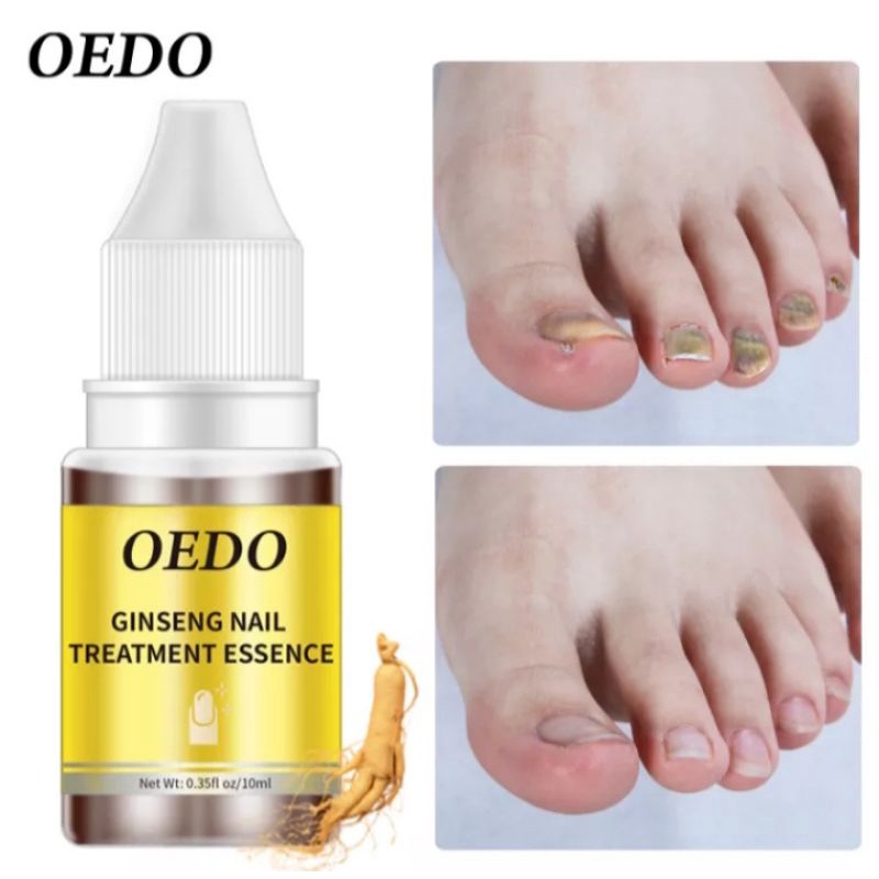 OEDO TREATMENT KUKU ANTI BAKTERI, PERBAIKAN KUKU