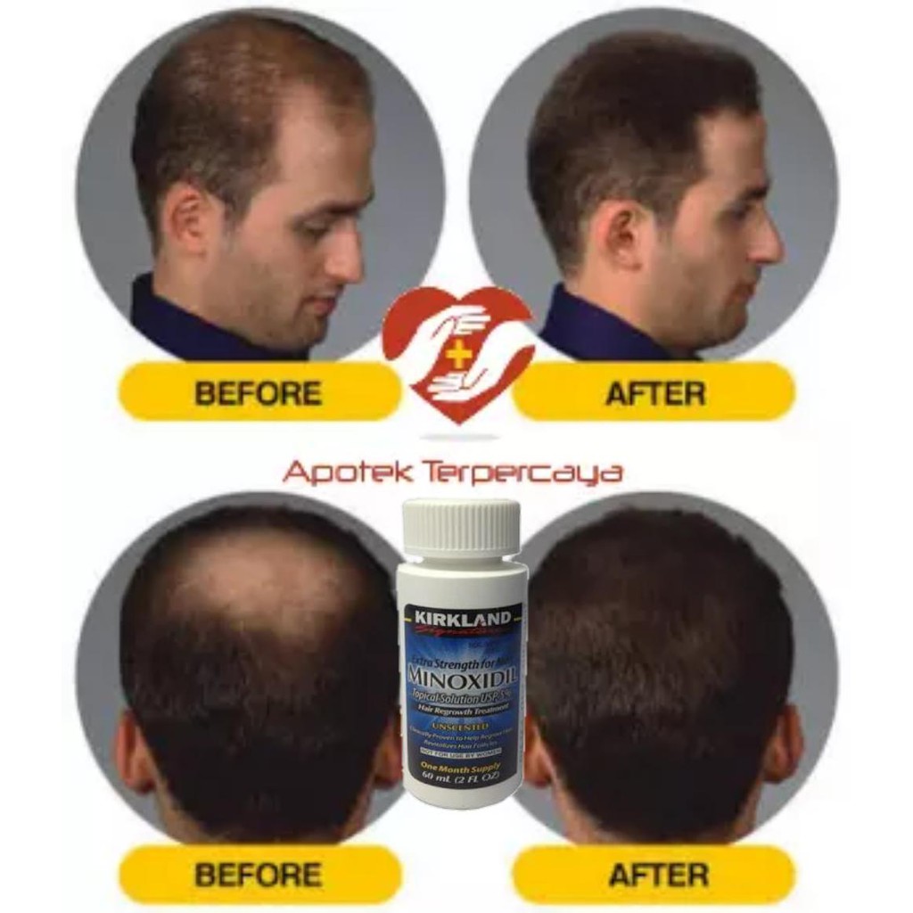 Obat Penumbuh Rambut Botak Dengan Cepat Obat Rambut Rontok Terbaik Obat Penumbuh Rambut Botak Dengan Cepat Obat Rambut Rontok Terbaik