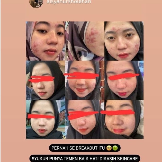 PAKET ACNE  BY AMSKINCARE | AMPUH USIR JERAWAT BANDEL