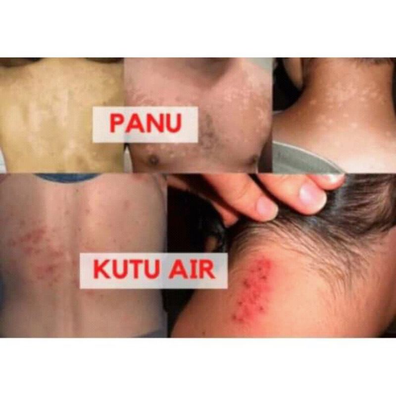 Grade Ori Obat Biduran Alergi Ampuh Saleb BL Original 100% Asli salep gatel selangkangan jamur Pi Kang Shuang panu kadas kudis kurap bruntusan-8