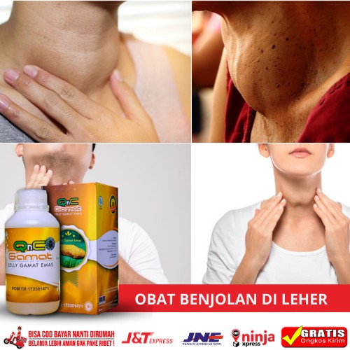 Obat Benjolan di Leher, Obat Penghilang Benjolan Leher, Obat Pengempes Benjolan di Leher | QNC GAMAT