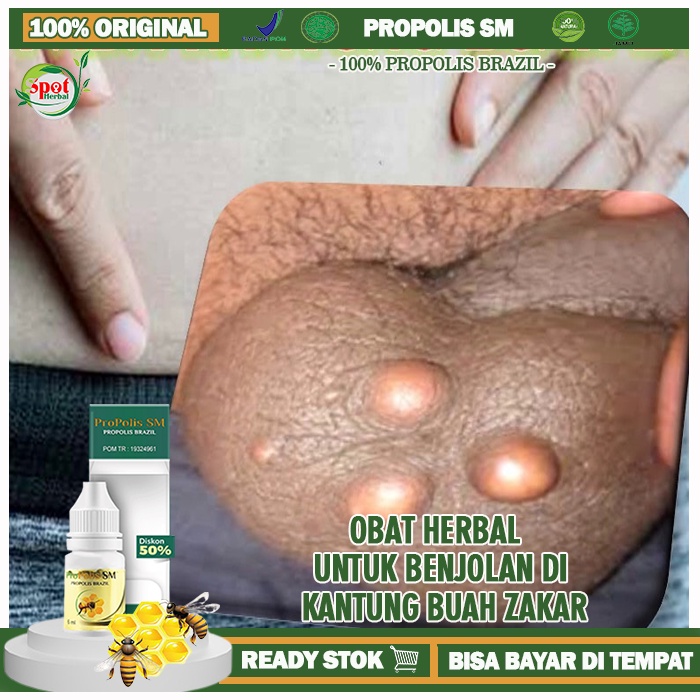 Obat Benjolan Di Buah Zakar, Obat Benjolan Di Kulit Buah Zakar, Obat Buah Zakar Bengkak, Obat Pengem