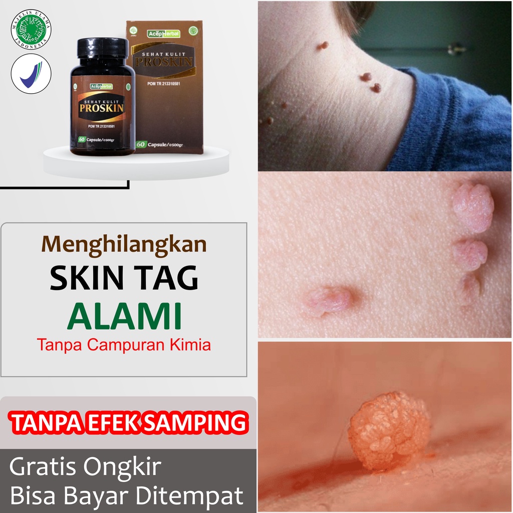 Herbal Penghilang Skin Tag Kutil Papiloma Paling Alami untuk Menghilangkan Jengger Ayam pada Anak da