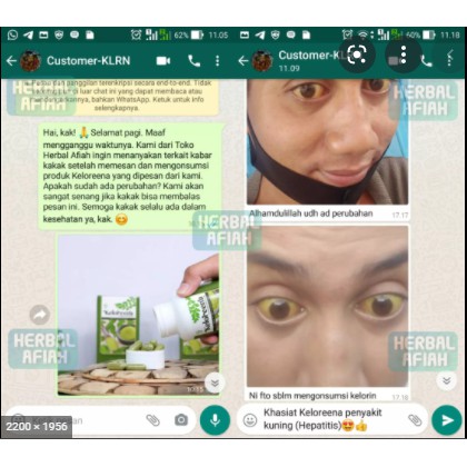 Obat Penyakit Kuning Mata Kuning Kulit Kuning, Obat Hepatitis, Hepatitis A B Dan C, Obat Liver, Liver Membengkak, Obat Liver Paling, Obat Pembengkakan Hati, Obat Limpa Herbal Dengan Keloreena Ekstra Daun Kelor