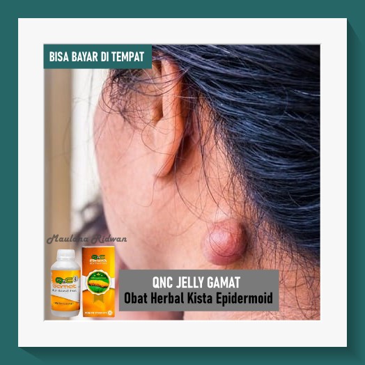 Obat Kista Epidermoid, Benjolan Di Bawah Kulit, Benjolan Di Punggung, Obat Herbal Kista Kulit