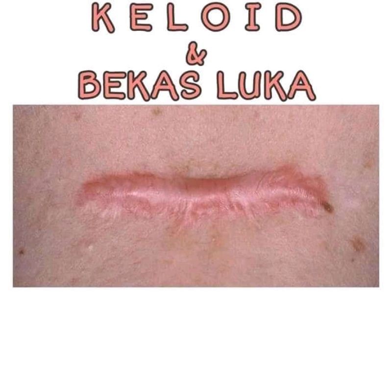 PENGHILANG BEKAS LUKA AMPUH