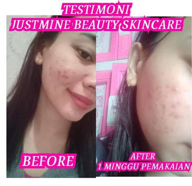 acne more justmine