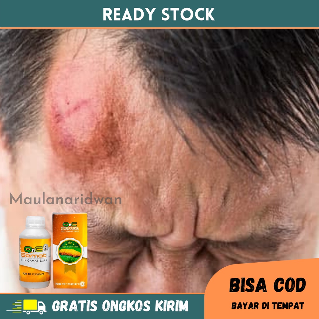 Obat Pengempis Benjolan - Obat Benjolan Di Jidat, Obat Benjolan Keras Di Jidat, Obat Benjolan Di Kep