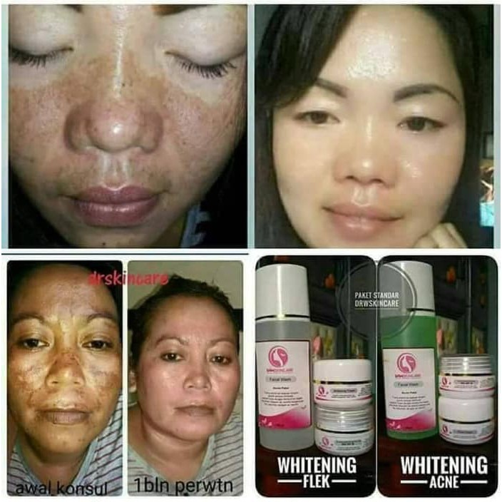Drw Skincare Paket Flek Hitam Lengkap Komplit Bpom Original 100 Shopee Indonesia