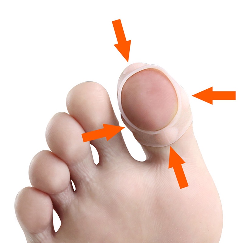 (Happy) 1 Pasang Separator Jari Kaki Bahan Silikon Untuk Bunion / Hallux Valgus