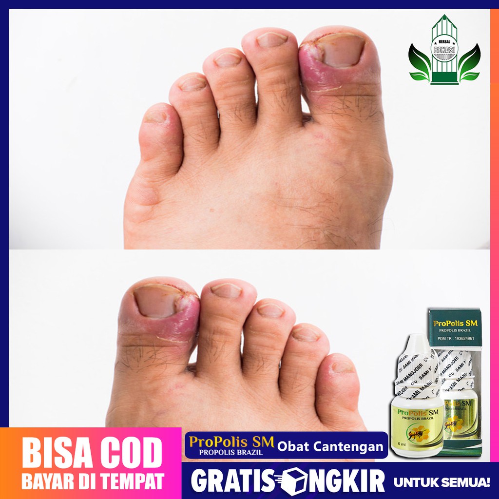 obat cantengan/ kaki bengkak asli 100% original propolis sm