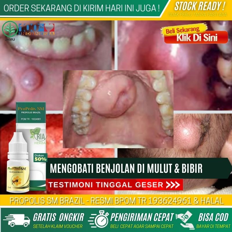 OBAT PENGEMPIS POLIP PULPA MEMBESAR, OBAT TETES ANTIBIOTIK UNTUK POLIP GIGI, PENGOBATAN POLIP DI GIG