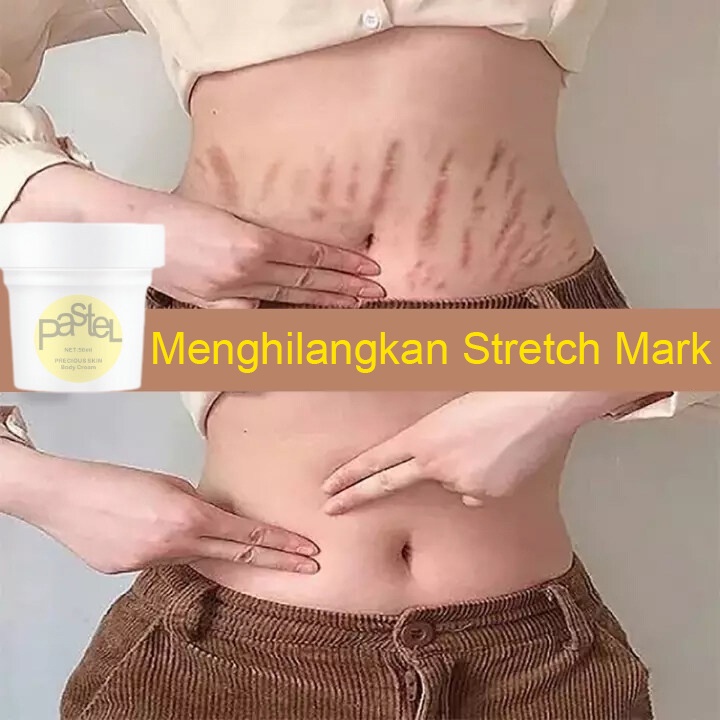 Krim stretch mark Mengencangkan meudarkan garis pasca persalinan/Menghilangkan stretch mark Menghilangkan garis penumbuhan/Perbaikan stretch mark Menghilangkan garis penumbuhan/Khusus pengguna ibu hamil Perbaikan stretch mark