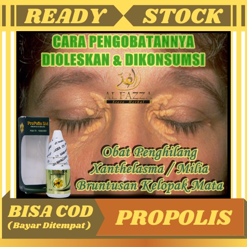 Obat Oles Xanthelasma, Obat Penghilang Xanthelasma, Gumpalan Lemak Di Kelopak Mata, Plak Kuning Keku