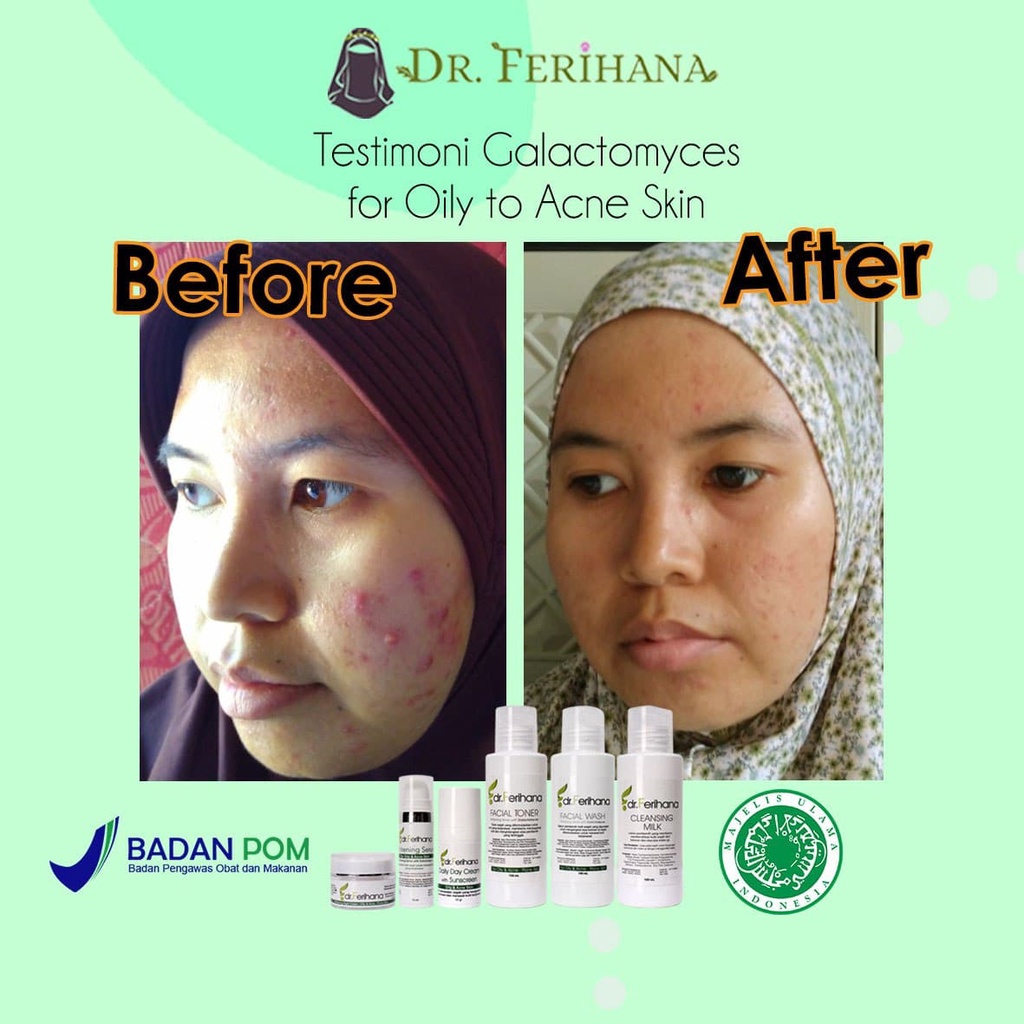 Galactomyces Day Cream For Oily &amp; Acne - Prone Skin DR. FERIHANA COSMETICS &amp; SKINCARE Krim Siang untuk Mengatasi Kulit Berminyak Berjerawat Bekas Jerawat Mencerahkan Sekaligus Anti Aging BPOM LPPOM HALAL MUI