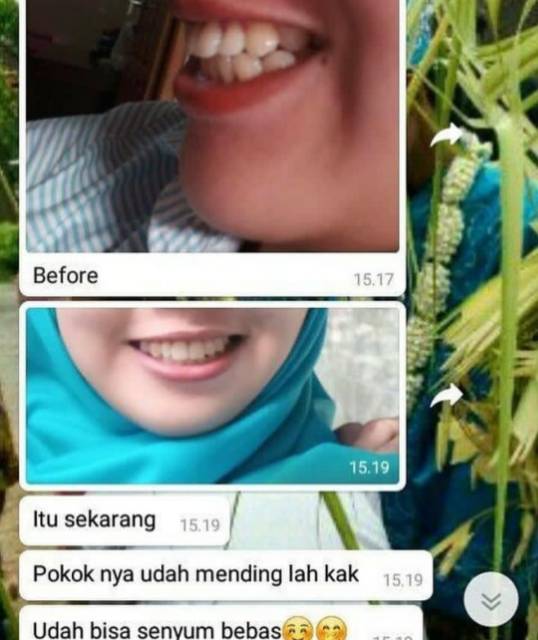 Teeth Trainer Original - Behel Lepas Pasang - Behel Ajaib - Termurah