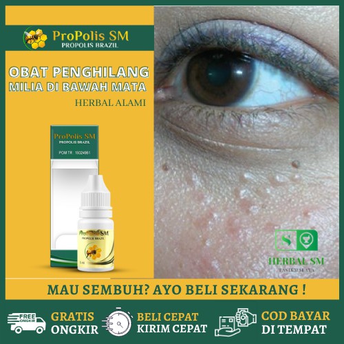 Obat Milia Bintik Di Dekat Mata Dan Kelopak Mata Obat Penghilang Milia Membandel Propolis Sm Shopee Indonesia