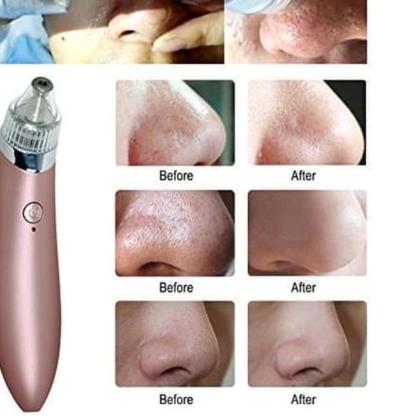 ➳ ALAT PENYEDOT KOMEDO DAN JERAWAT BEAUTY SKIN CARE CW - 666 ◘