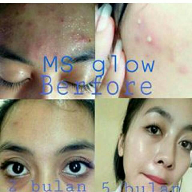 [FREE GIFT] MS GLOW Paket Wajah whitening/ acne /ultimate /white luminous ORIGINAL