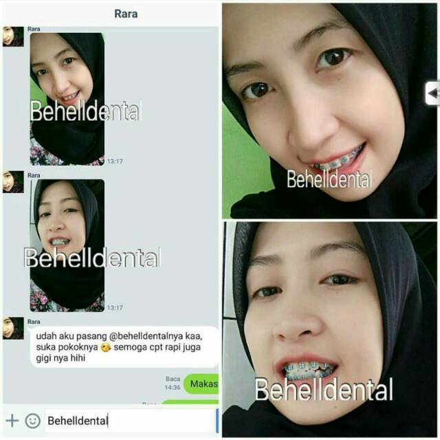 PAKET BEHEL ORIGINAL PERMANEN METAL ORTHO BRACKET FANCY ORENS OREN ORANGE ROTH WITH HOOK - Braces Dental Untuk Perbaikan / Perawatan Gigi - Kawat Orthodontic Metalic Untuk Perawatan Gigi Berantakan - Behelldental