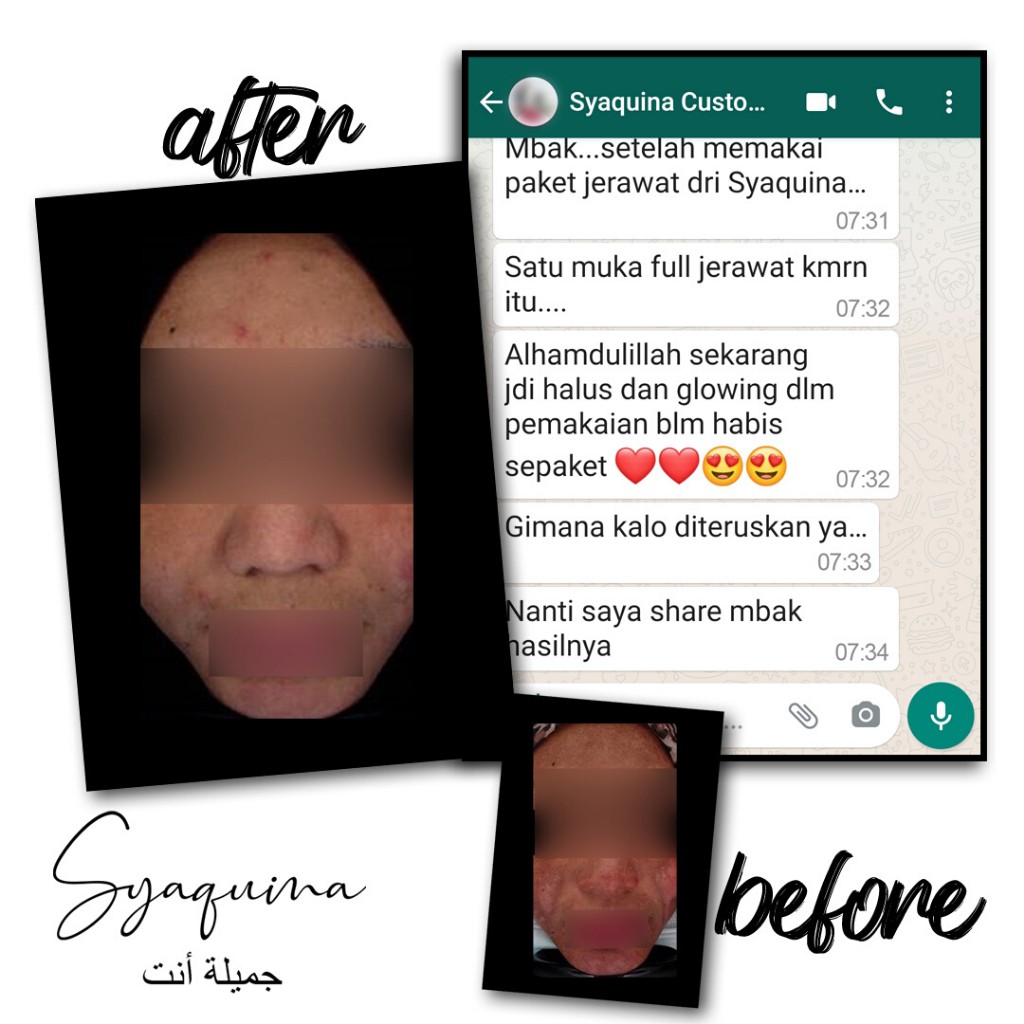 Syaquina Expert Paket Acne Series / Skincare Kulit Jerawat & Berminyak / Formulasi Dokter BPOM & MUI-3