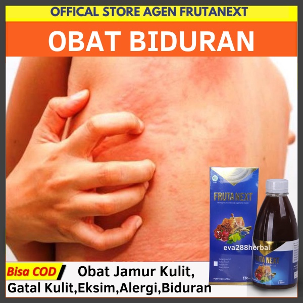 Frutanext Obat Biduran Gatal Alergi Dingin Kaligata Untuk Anak dan Dewasa Menahun Kronis Fruta Next 