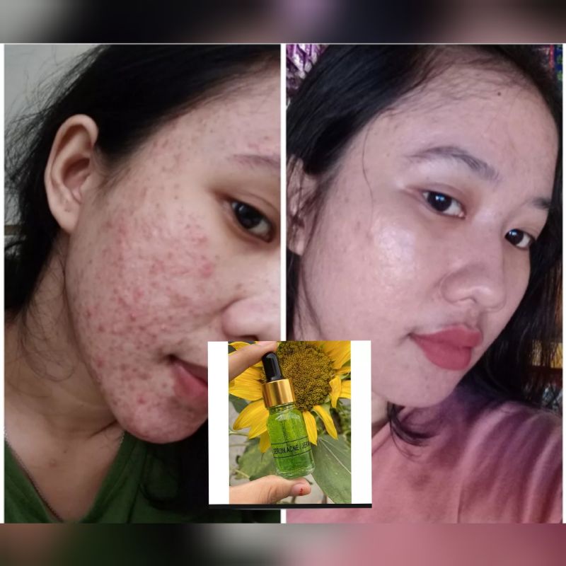 SERUM ACNE FARMA KUSUS JERAWAT 10ml