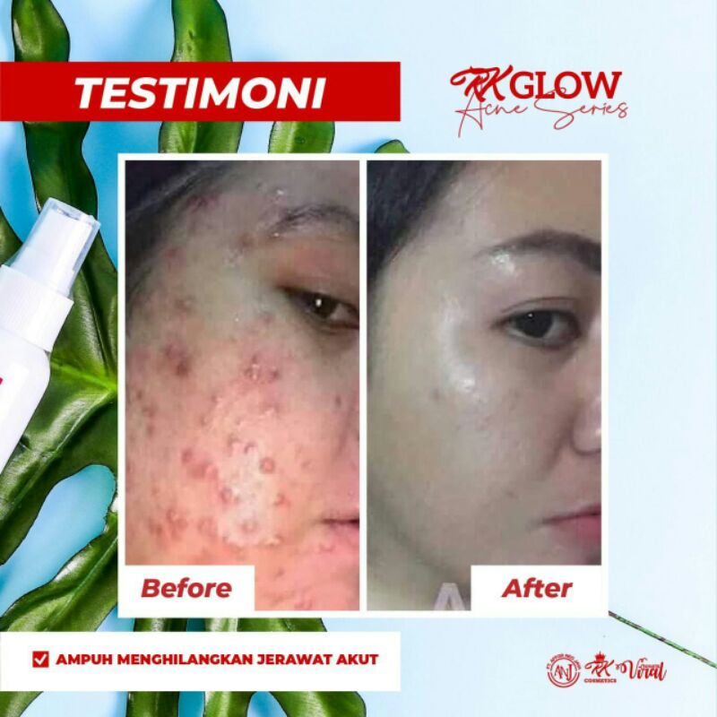 Rk Glow ACNE