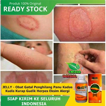 JELLY - Obat Gatal Penghilang Panu Kadas Kudis Kurap Gudik Herpes Eksim Alergi | Bukan Obat Cina BL