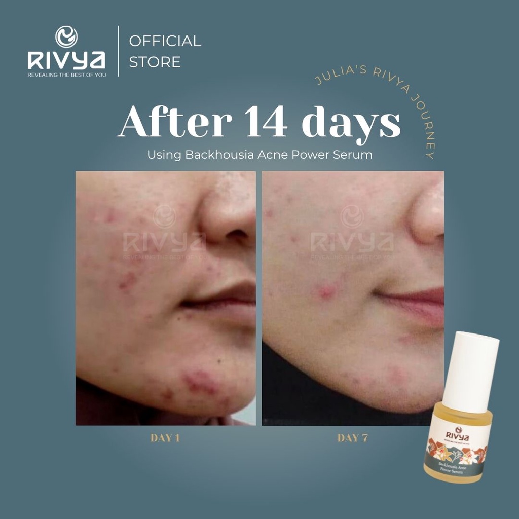 RIVYA Backhousia Acne Power Serum 20ml Serum Untuk Jerawat Aman Untuk  Busui dan Bumil