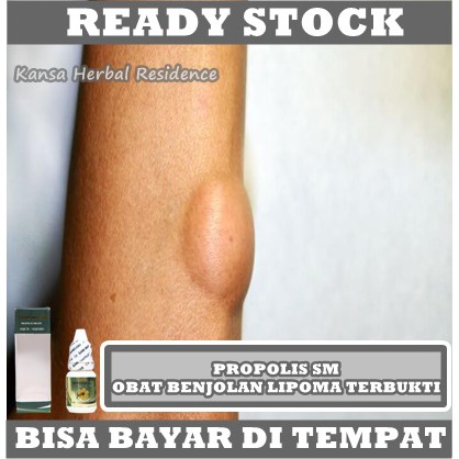 Obat Penghilang Benjolan Abnormal di Tubuh, Obat Benjolan Lipoma, Obat Kista Ganglion, Solusi Menghilangkan Benjolan, Obat Penghancur Benjolan Lipoma Tyroid - Tiroid - Gondok - Kelenjar Getah Bening Dengan Propolis SM 100% ORIGINAL ASLI