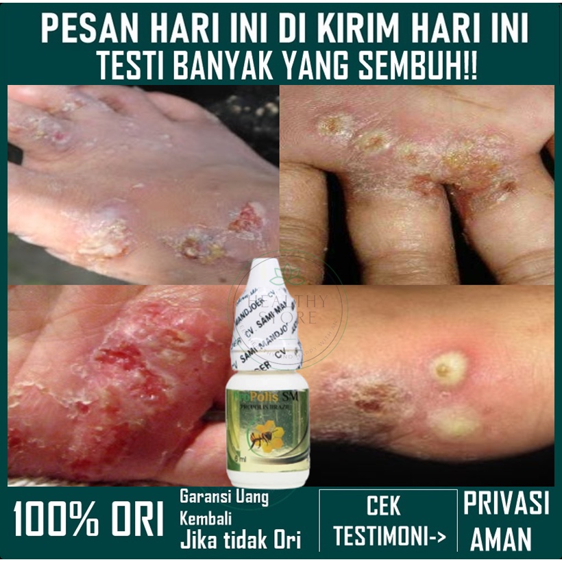Jual OBAT BUDUG DI KAKI, BUDUG BERNANAH / GUDIK DI KAKI, BUDUG SANTRI