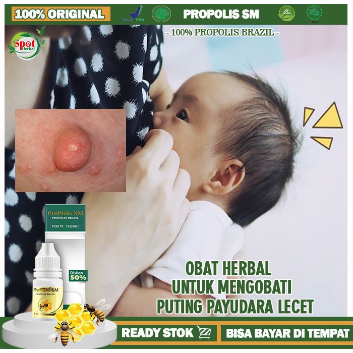 Obat Puting Payudara Lecet, Mengobati Puting Lecet Saat Menyusui, Obat Alami untuk Mengatasi Puting 