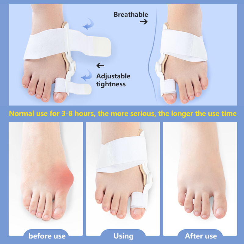 Big Bone Toe Bunion Splint Toe Straightener Corrector Koreksi Hallux Valgus Perlengkapan Ortopedi