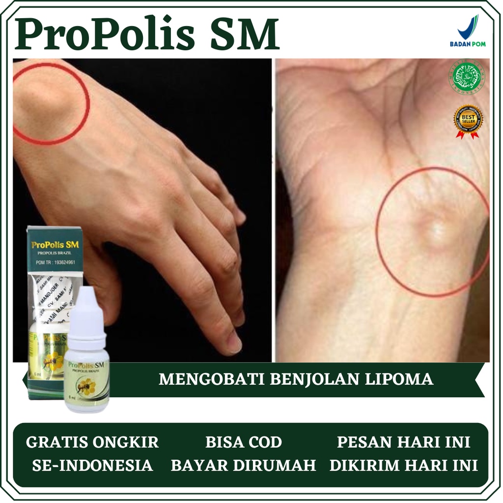 Obat Benjolan di Tangan, Obat Benjolan Lipoma, Obat Benjolan Ganglion, Obat Benjolan Kista, Obat Ben