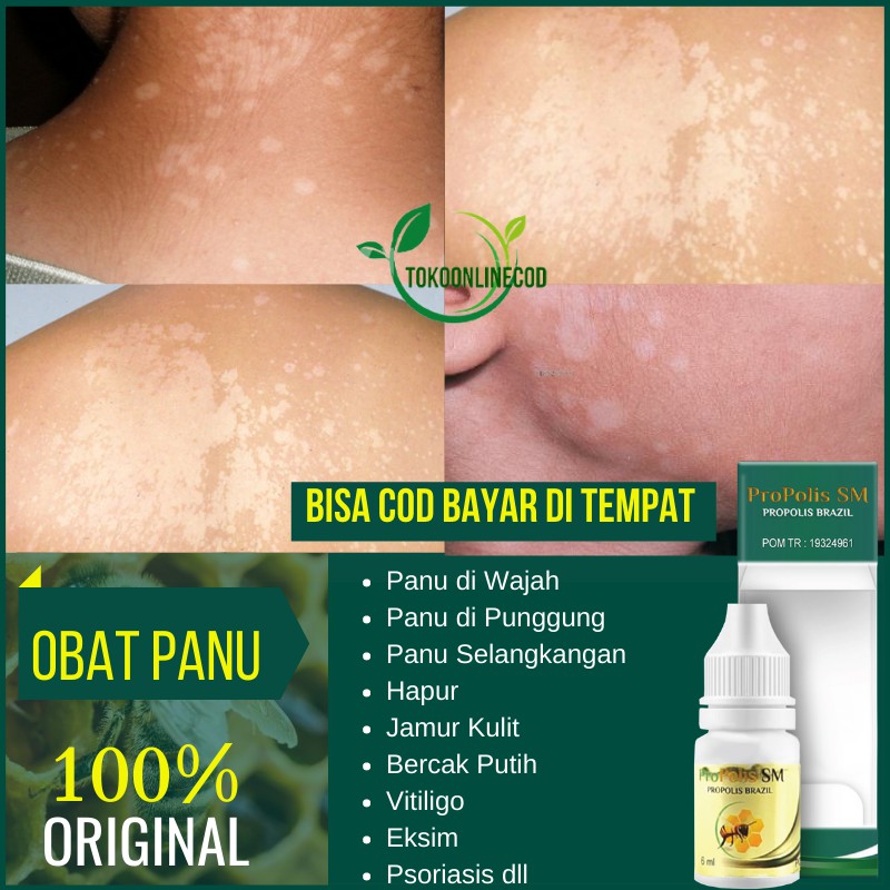 Obat Panu Cair Anak Kadas Kurap Jamur Kulit Hapur Hapuran di Wajah Selangkangan Menahun Propolis Sm