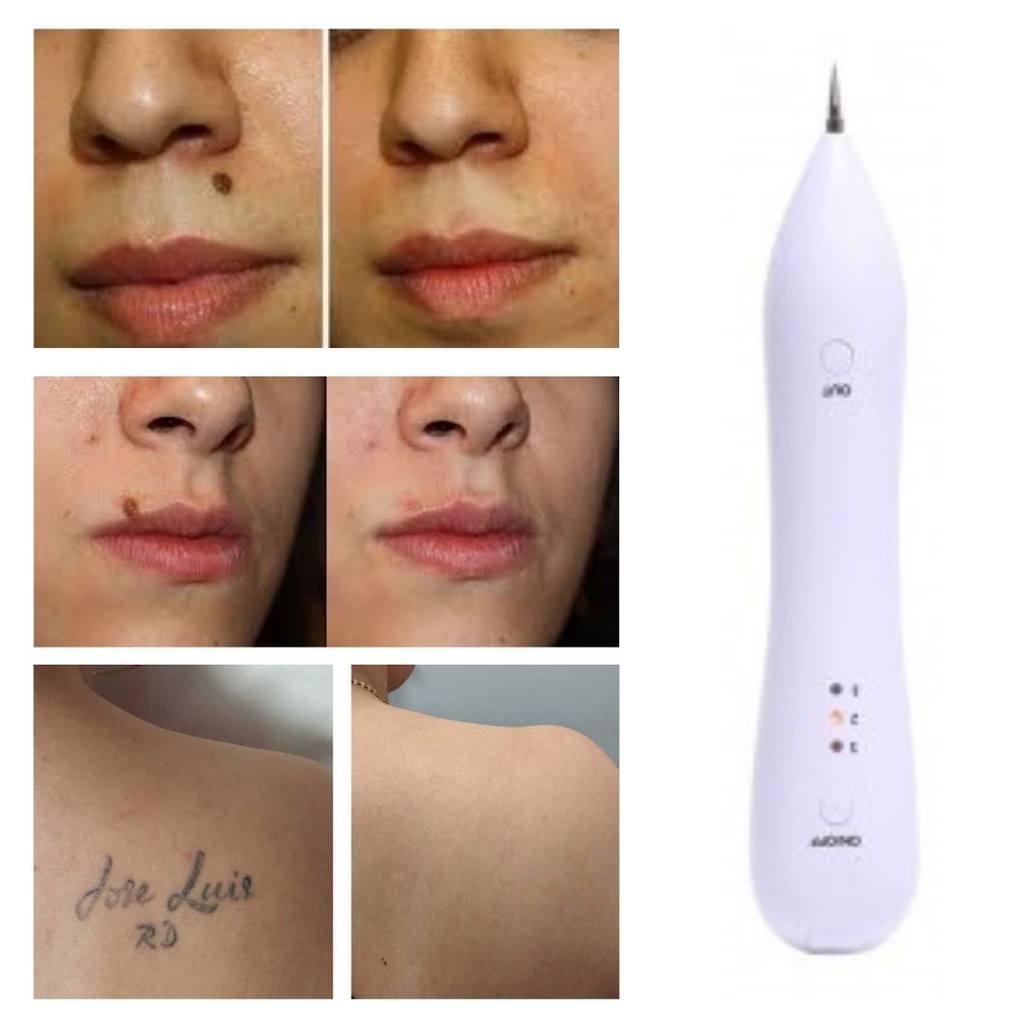 Alat Penghilang Spot Hitam Kulit Kutil Tahi Lalat Tatto Remover Pen 111