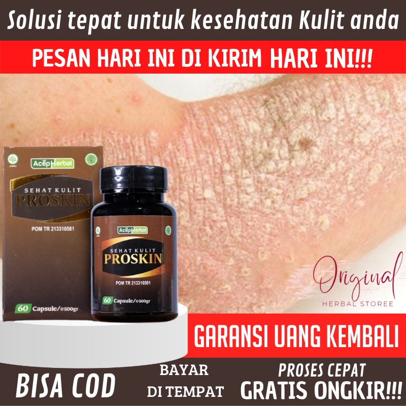 Salep eksim kering, Salep scabies, Obat Gatal Eksim, Salep eksim kering Menahun, Obat eksim kering, 
