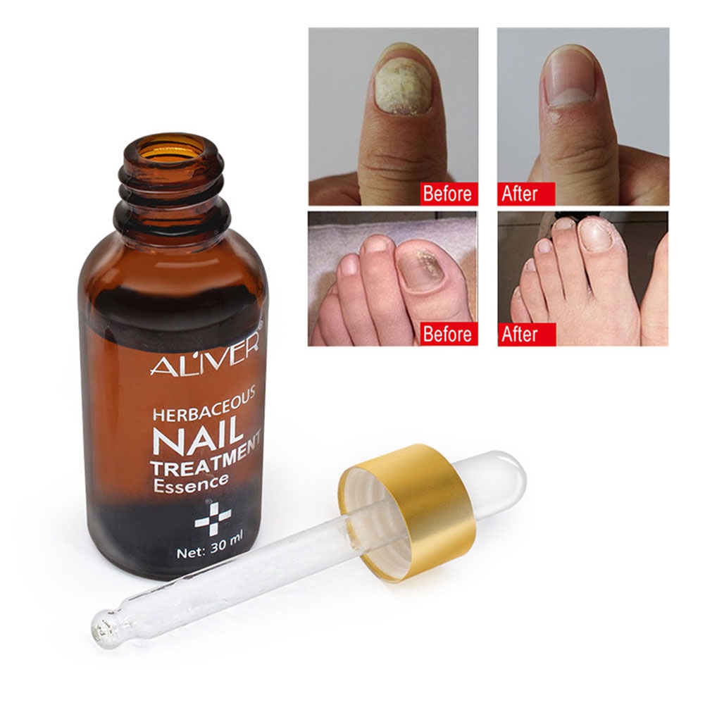 30ml Nail Fungus Treatment Liquid Herbs Medicine Anti Fungal Removal Infection Shopee Indonesia