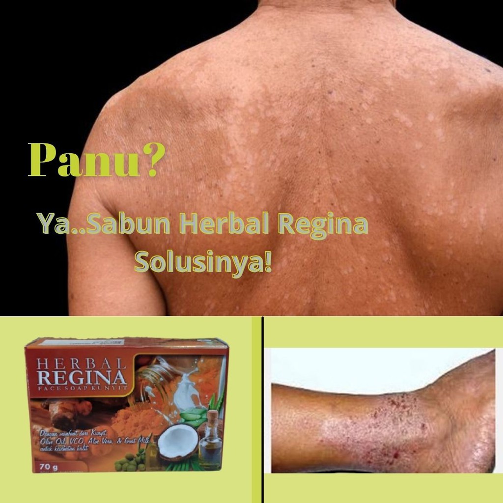 Sabun Herbal Regina 100 Original Alami Menghilangkan Bekas Kudis Kurap Panu Gatal Gatal Shopee Indonesia