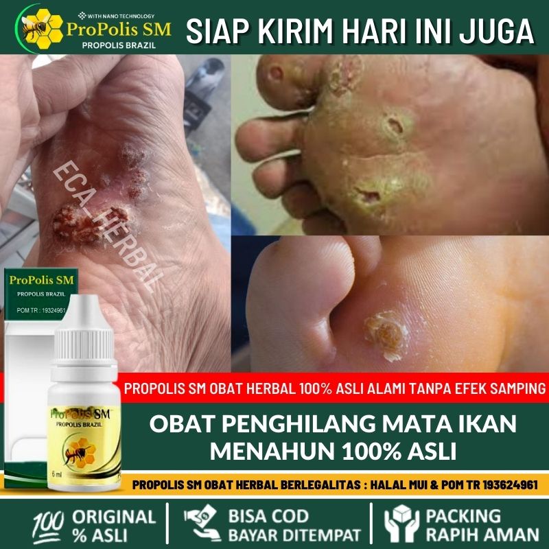 Obat Perontok Mata Ikan Menahun 100% ASLI - Penghilang Mata Ikan di Telapak Kaki, Obat  Tetes Cair U