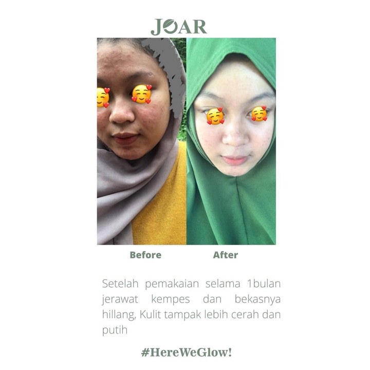 VIRAL !! - JOAR SKINCARE Paket Soap Bar dan Brightening Serum 100% Original - Sabun Wajah Pemutih Kulit Aman BPOM