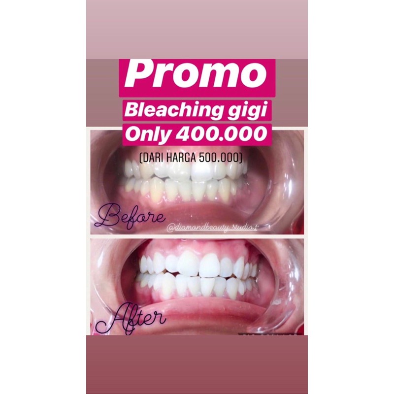 Bleaching Gigi