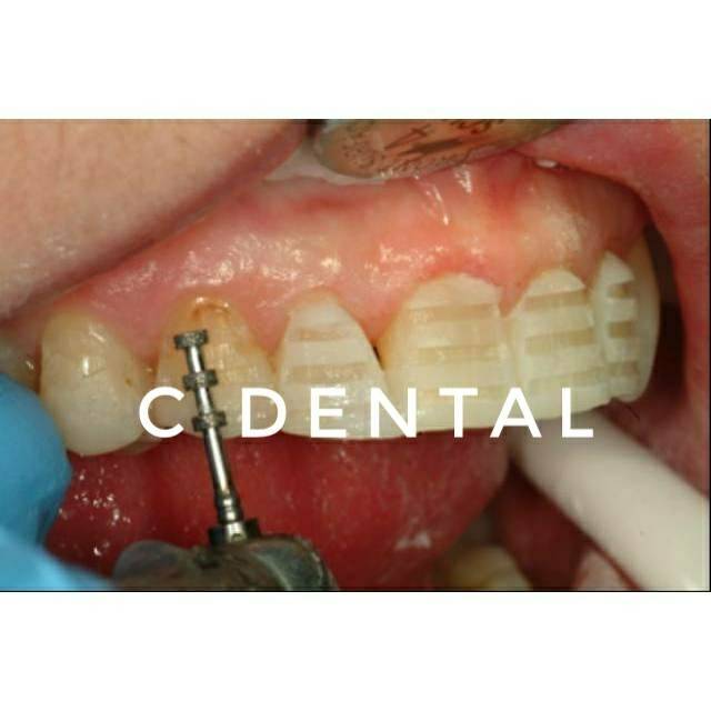 Jual Dental Veneer Labial Depth Marker Cutter Diamond Bur Indonesia