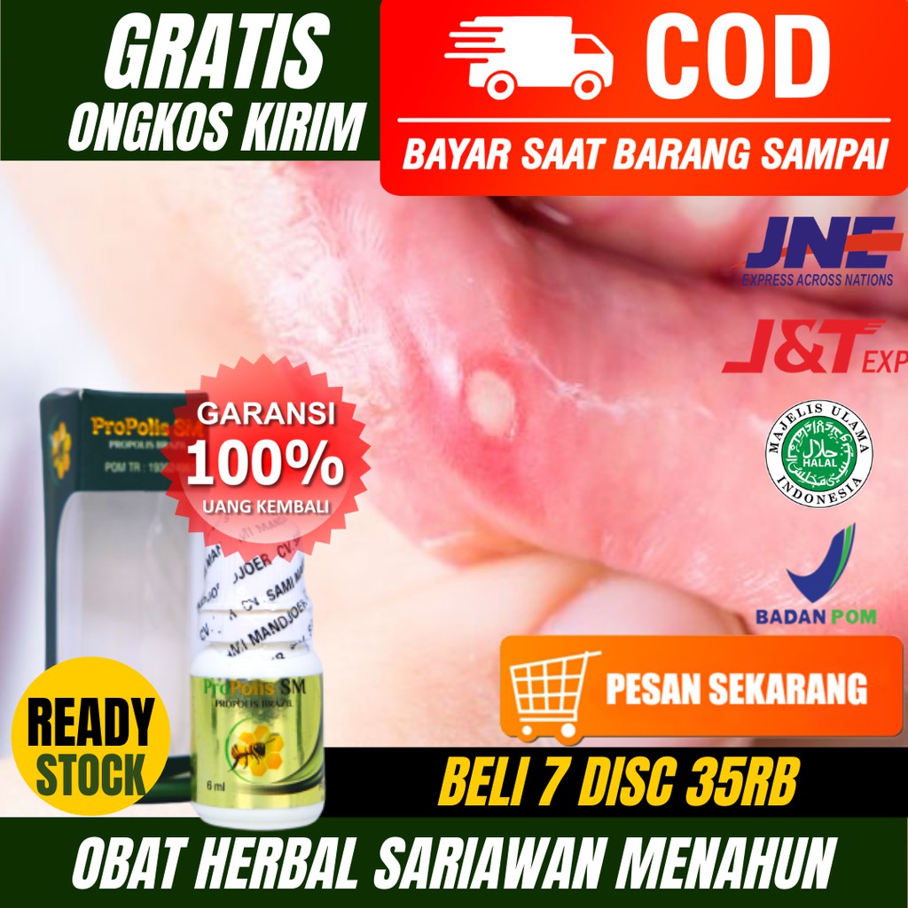 Obat Sariawan Menahun_Sariawan Anak dan Dewasa_Luka Pada Bibir_Obat Kumur_Obat Tetes_Propolis SM