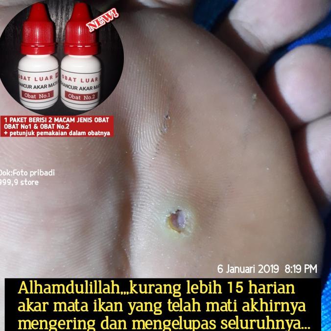 READY STOCK Obat penyakit clavus atau mata ikan bukan plester salep callusol Murah