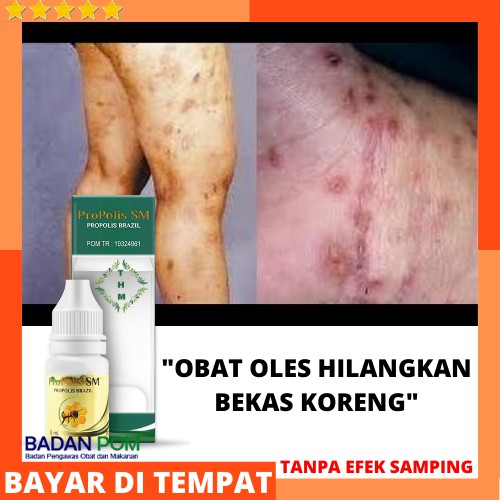 Obat Salep Menghilangkan Bekas Koreng Korengan Hitam Gatal Gatel Eksim Kering Borok Bernanah Gudikan