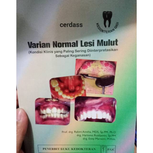 Varian Normal Lesi Mulut